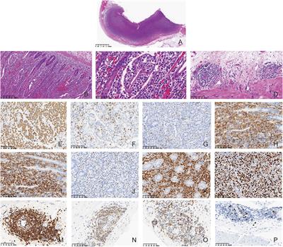 Case report: Chronic lymphocytic leukemia/small lymphocytic lymphoma and monomorphic epitheliotropic intestinal T-cell lymphoma: A composite lymphoma